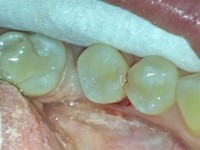 Bolesti zuba 2